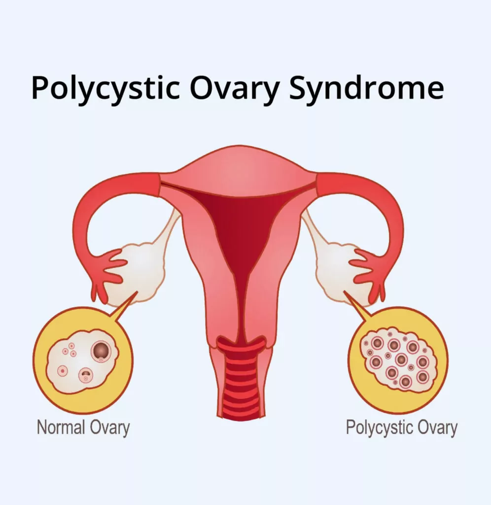 PCOD Diagnosis Illustration