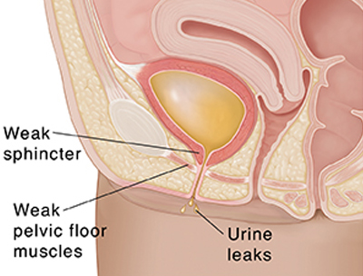 Incontinence Treatment