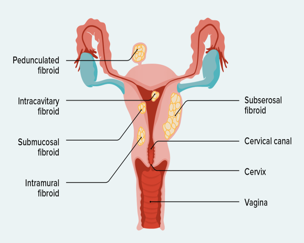 Infertility Treatment